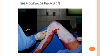 SULFADIAZINA DE PRATA A 1%
 