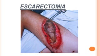 ESCARECTOMIA
 