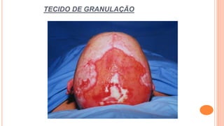 TECIDO DE GRANULAÇÃO
 