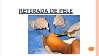 RETIRADA DE PELE
 