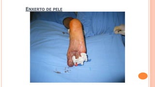 ENXERTO DE PELE
 