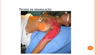 TECIDO DE GRANULAÇÃO
 