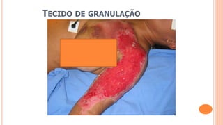 TECIDO DE GRANULAÇÃO
 