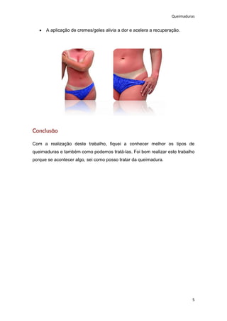 Queimaduras


      A aplicação de cremes/geles alivia a dor e acelera a recuperação.




Conclusão

Com a realização deste trabalho, fiquei a conhecer melhor os tipos de
queimaduras e também como podemos tratá-las. Foi bom realizar este trabalho
porque se acontecer algo, sei como posso tratar da queimadura.




                                                                             5
 