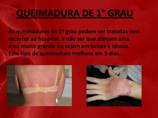 QUEIMADURA DE 1° GRAU
As queimaduras de 1º grau podem ser tratadas sem
recorrer ao hospital, a não ser que atinjam uma
área muito grande ou sejam em bebés e idosos.
Este tipo de queimadura melhora em 3 dias.

 