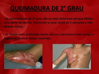 QUEIMADURA DE 2° GRAU
- As queimaduras de 2º grau são as mais dolorosas porque afetam
uma parte da derme. Demoram a curar cerca de 3 semanas e não
deixam marca.
- Se forem mais profundas doem menos e demoram mais tempo a
regenerar. Podem deixar cicatrizes.

 