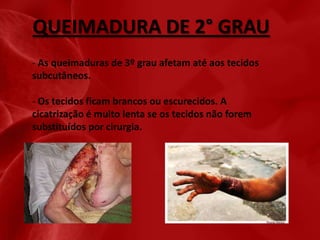 QUEIMADURA DE 2° GRAU
- As queimaduras de 3º grau afetam até aos tecidos
subcutâneos.

- Os tecidos ficam brancos ou escurecidos. A
cicatrização é muito lenta se os tecidos não forem
substituídos por cirurgia.

 