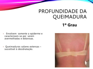 PROFUNDIDADE DA
QUEIMADURA
• Envolvem somente a epiderme e
caracterizam-se por serem
avermelhadas e dolorosas.
• Queimaduras solares extensas –
suscetível à desidratação.
1º Grau
 