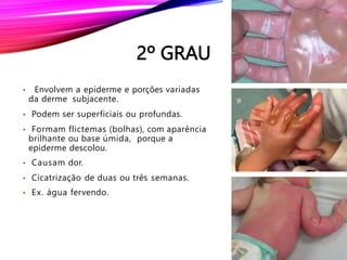 2º GRAU
• Envolvem a epiderme e porções variadas
da derme subjacente.
• Podem ser superficiais ou profundas.
• Formam flictemas (bolhas), com aparência
brilhante ou base úmida, porque a
epiderme descolou.
• Causam dor.
• Cicatrização de duas ou três semanas.
• Ex. água fervendo.
 