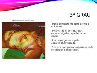 3º GRAU
• Dano completo de toda derme e
epiderme.
• Lesões são espessas, secas,
esbranquiçadas, aparência de
couro.
• Em casos graves a pele
aparece chamuscada.
• Sentem dor, pois a espessura pode
ser parcial e superficial.
 