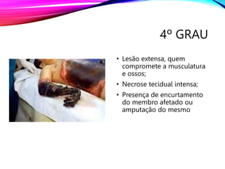 4º GRAU
• Lesão extensa, quem
compromete a musculatura
e ossos;
• Necrose tecidual intensa;
• Presença de encurtamento
do membro afetado ou
amputação do mesmo
 