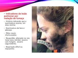 • Indicadores de lesão
pulmonar por
inalação de fumaça
• História indicando que a
queimadura ocorreu em
área restrita;
• Queimadura de face e
pescoço;
• Pêlos nasais
chamuscados;
• Rouquidão, alteração na voz,
tosse seca, estridor, escarro
com fuligem, escarro
saguinolento;
• Respiração difícil ou
taquipnéia.
 