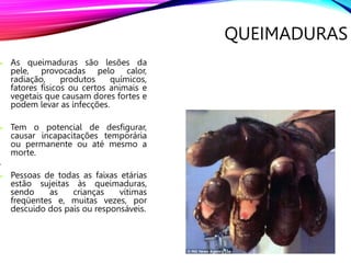 3
QUEIMADURAS
 As queimaduras são lesões da
pele, provocadas pelo calor,
radiação, produtos químicos,
fatores físicos ou certos animais e
vegetais que causam dores fortes e
podem levar as infecções.
 Tem o potencial de desfigurar,
causar incapacitações temporária
ou permanente ou até mesmo a
morte.
•
 Pessoas de todas as faixas etárias
estão sujeitas às queimaduras,
sendo as crianças vítimas
freqüentes e, muitas vezes, por
descuido dos pais ou responsáveis.
 