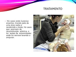 TRATAMENTO
• Há casos onde é preciso
enxertos, tirando pele de
uma área sadia e
recobrindo a lesão, há casos
que precisam de
reconstituição plástica, e
há lesões de extremidades
onde há necrose levando a
amputar.
 