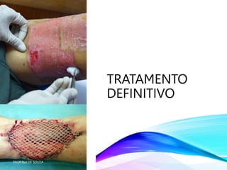 TRATAMENTO
DEFINITIVO
PROF RUI DE SOUZA
 