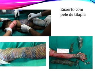 Enxerto com
pele de tilápia
 