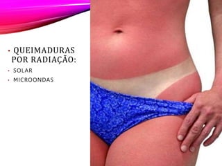 Q
U
E
I
M
A
D
U
R
A
P
O
R
R
A
D
I
A
Ç
Ã
O
• QUEIMADURAS
POR RADIAÇÃO:
• SOLAR
• MICROONDAS
 