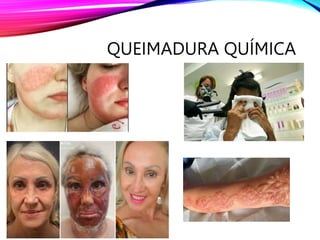 QUEIMADURA QUÍMICA
 