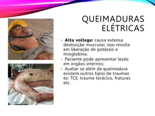 QUEIMADURAS
ELÉTRICAS
• Alta voltage: causa extensa
destruição muscular, isso resulta
em liberação de potássio e
mioglobina.
• Paciente pode apresentar lesão
em orgãos internos;
• Avaliar se além da queimadura
existem outros tipos de traumas
ex: TCE, trauma torácico, fraturas
etc.
 
