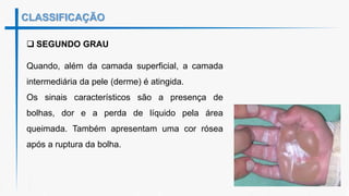 CLASSIFICAÇÃO
 SEGUNDO GRAU
Quando, além da camada superficial, a camada
intermediária da pele (derme) é atingida.
Os sinais característicos são a presença de
bolhas, dor e a perda de líquido pela área
queimada. Também apresentam uma cor rósea
após a ruptura da bolha.
 