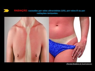 RADIAÇÃO: causadas por raios ultravioletas (UV), por raios-X ou por 
radiações ionizantes. 
(Revista Brasileira de Queimaduras) 
 