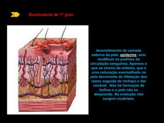 Queimadura de 1º grau 
Acometimento da camada 
externa da pele, epiderme, sem 
modificar os padrões da 
circulação sanguínea. Aparece o 
que se chama de eritema, que é 
uma coloração avermelhada na 
pela decorrente da dilatação dos 
vasos seguida de inchaço e dor 
variável. Não há formação de 
bolhas e a pele não se 
desprende. Na evolução não 
surgem cicatrizes. 
 