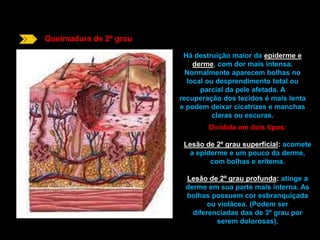 Queimadura de 2º grau 
Há destruição maior da epiderme e 
derme, com dor mais intensa. 
Normalmente aparecem bolhas no 
local ou desprendimento total ou 
parcial da pele afetada. A 
recuperação dos tecidos é mais lenta 
e podem deixar cicatrizes e manchas 
claras ou escuras. 
Dividida em dois tipos: 
Lesão de 2º grau superficial: acomete 
a epiderme e um pouco da derme, 
com bolhas e eritema. 
Lesão de 2º grau profunda: atinge a 
derme em sua parte mais interna. As 
bolhas possuem cor esbranquiçada 
ou violácea. (Podem ser 
diferenciadas das de 3º grau por 
serem dolorosas). 
 