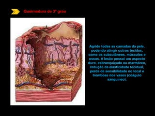 Queimadura de 3º grau 
Agride todas as camadas da pele, 
podendo atingir outros tecidos, 
como os subcutâneos, músculos e 
ossos. A lesão possui um aspecto 
duro, esbranquiçado ou marmóreo, 
redução da elasticidade tecidual, 
perda de sensibilidade no local e 
trombose nos vasos (coágulo 
sanguíneo). 
 