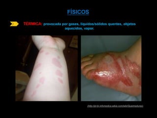 FÍSICOS 
TÉRMICA: provocada por gases, líquidos/sólidos quentes, objetos 
aquecidos, vapor. 
(http://pt-br.infomedica.wikia.com/wiki/Queimaduras) 
 