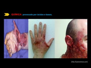 QUÍMICA: provocada por ácidos e bases. 
(http://hypescience.com) 
 