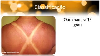 Classificação 
Queimadura 1º 
grau 
 