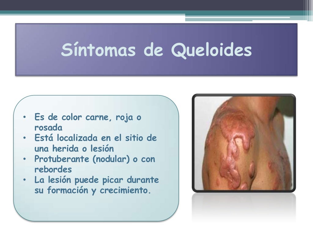 Queloides 1 1 1 queloides-1-1-1