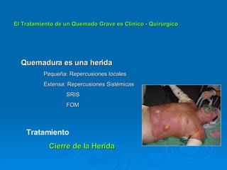 El Tratamiento de un Quemado Grave es Clínico - Quirúrgico Quemadura es una herida Pequeña: Repercusiones locales Extensa: Repercusiones Sistémicas SRIS FOM Tratamiento Cierre de la Herida 