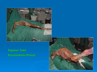 Espesor Total Escarectomía Precoz 