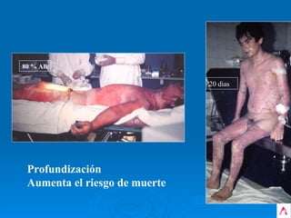Profundización  Aumenta el riesgo de muerte 80 % AB 20 dias 