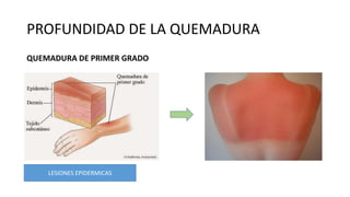 PROFUNDIDAD DE LA QUEMADURA
QUEMADURA DE PRIMER GRADO
LESIONES EPIDERMICAS
 