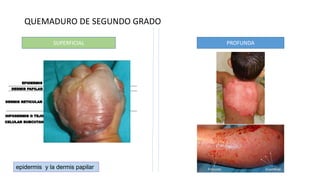QUEMADURO DE SEGUNDO GRADO
SUPERFICIAL PROFUNDA
epidermis y la dermis papilar
 