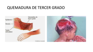 QUEMADURA DE TERCER GRADO
 