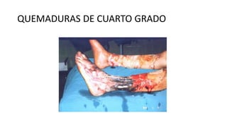 QUEMADURAS DE CUARTO GRADO
 