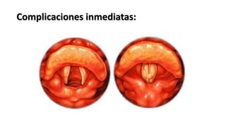 Complicaciones inmediatas:
 