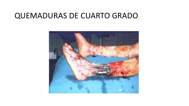 Quemaduras en Niños Quemaduras en Niños