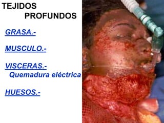 TEJIDOS 
PROFUNDOS 
GRASA.- 
MUSCULO.- 
VISCERAS.- 
Quemadura eléctrica 
HUESOS.- 
 