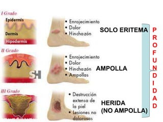 AMPOLLA 
P 
R 
O 
F 
U 
N 
D 
I 
D 
A 
D 
SOLO ERITEMA 
HERIDA 
(NO AMPOLLA) 
 