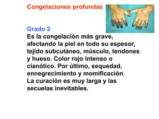 Congelaciones profundas 
Grado 2 
Es la congelación más grave, 
afectando la piel en todo su espesor, 
tejido subcutáneo, músculo, tendones 
y hueso. Color rojo intenso o 
cianótico. Por último, sequedad, 
ennegrecimiento y momificación. 
La curación es muy larga y las 
secuelas inevitables. 
 