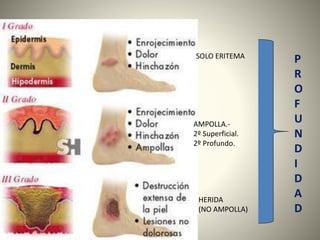 AMPOLLA.- 
2º Superficial. 
2º Profundo. 
P 
R 
O 
F 
U 
N 
D 
I 
D 
A 
D 
SOLO ERITEMA 
HERIDA 
(NO AMPOLLA) 
 
