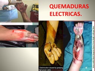 QUEMADURAS 
ELECTRICAS. 
 