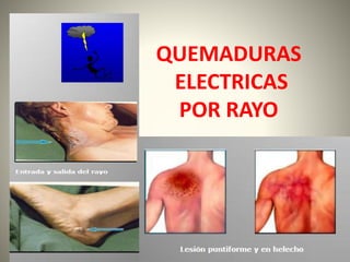 QUEMADURAS 
ELECTRICAS 
POR RAYO 
 