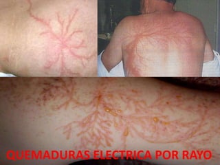 QUEMADURAS ELECTRICA POR RAYO 
 