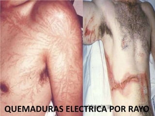 QUEMADURAS ELECTRICA POR RAYO 
 