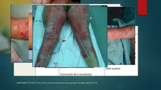 Características clínicas
MINISTERIO DE SALUD. Guía Clínica. Manejo del paciente gran quemado. Santiago: Minsal, 2016
 